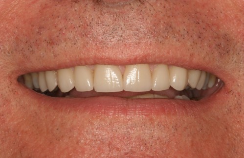 Craigs dental work by tellman dentistry