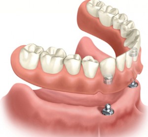 denture implant