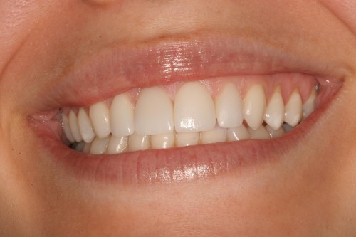 porcelian crown work tellman dentistry before